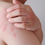 Svrbive vyrazky sa objavia v priebehu minut Chlad moze spustit aj zivot ohrozujucu reakciu